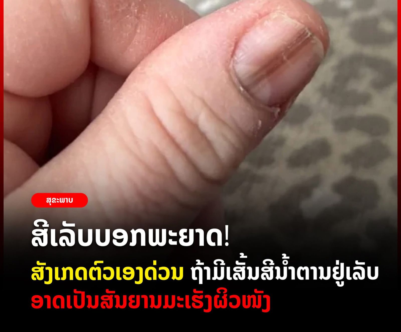 ສັງເກດຕົວເອງດ່ວນ! ເລັບມີຮອຍຊໍ້າລຸກລາມ ອາດເປັນມະເຮັງຜິວໜັງ